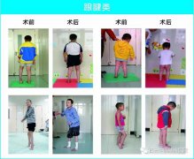 陕西省0—7岁肢体残疾儿童可以申请免费手术救助啦！