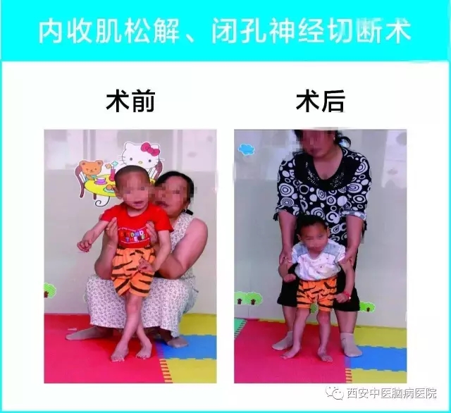 陕西省0—7岁肢体残疾儿童可以申请免费手术救助啦！